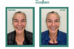 before-and-after-June2023-b